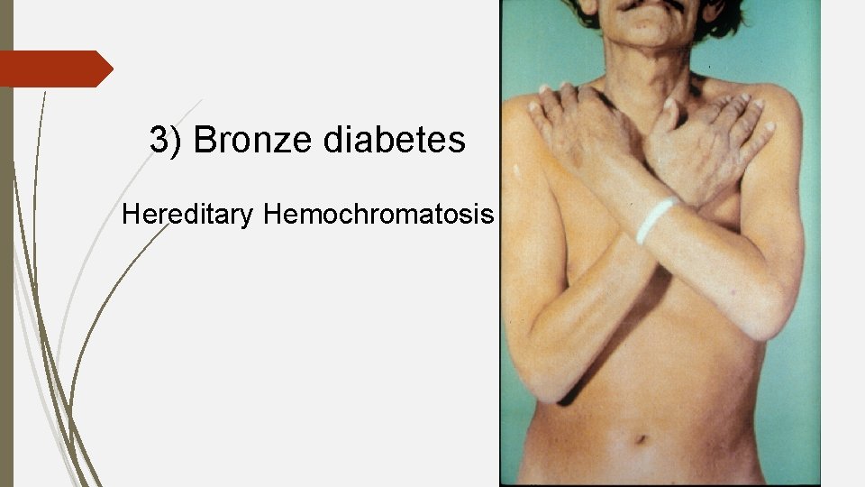 3) Bronze diabetes Hereditary Hemochromatosis 