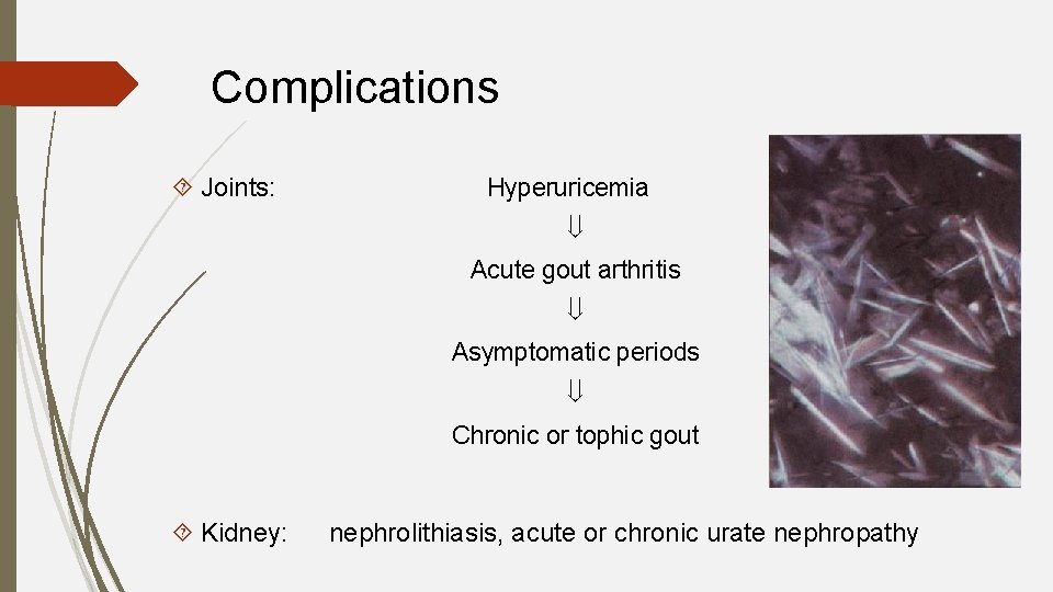 Complications Joints: Hyperuricemia Acute gout arthritis Asymptomatic periods Chronic or tophic gout Kidney: nephrolithiasis,