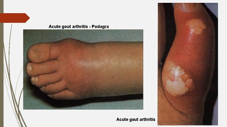 Acute gout arthritis - Podagra Acute gout arthritis 