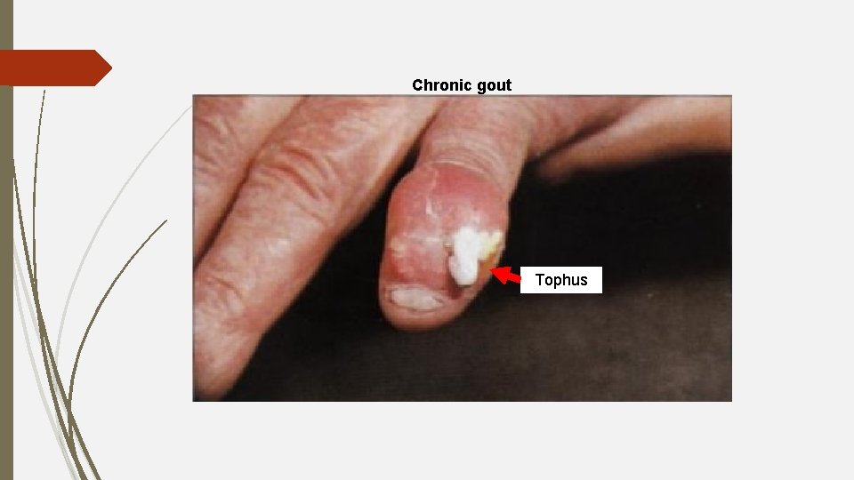 Chronic gout Tophus 