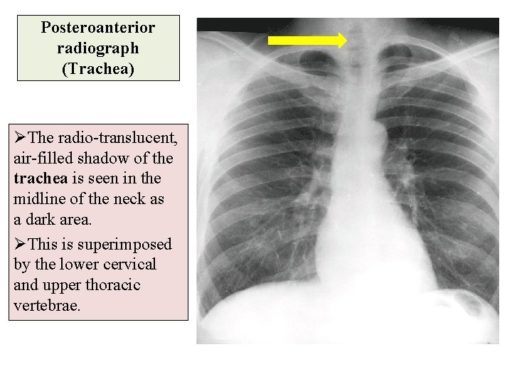 Posteroanterior radiograph (Trachea) ØThe radio-translucent, air-filled shadow of the trachea is seen in the