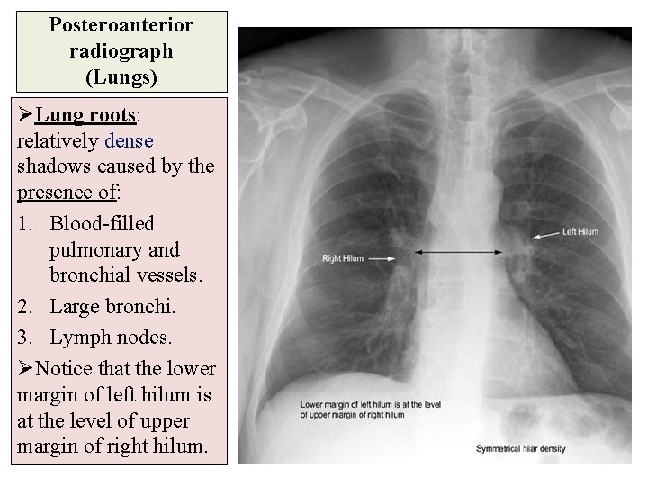 Posteroanterior radiograph (Lungs) ØLung roots: relatively dense shadows caused by the presence of: 1.