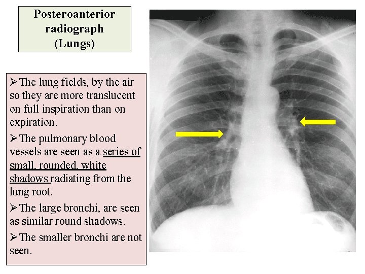 Posteroanterior radiograph (Lungs) ØThe lung fields, by the air so they are more translucent