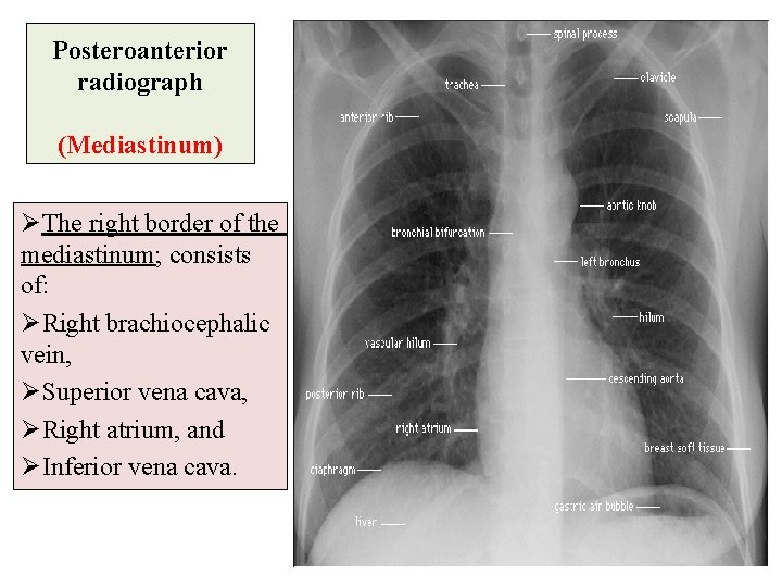 Posteroanterior radiograph (Mediastinum) ØThe right border of the mediastinum; consists of: ØRight brachiocephalic vein,