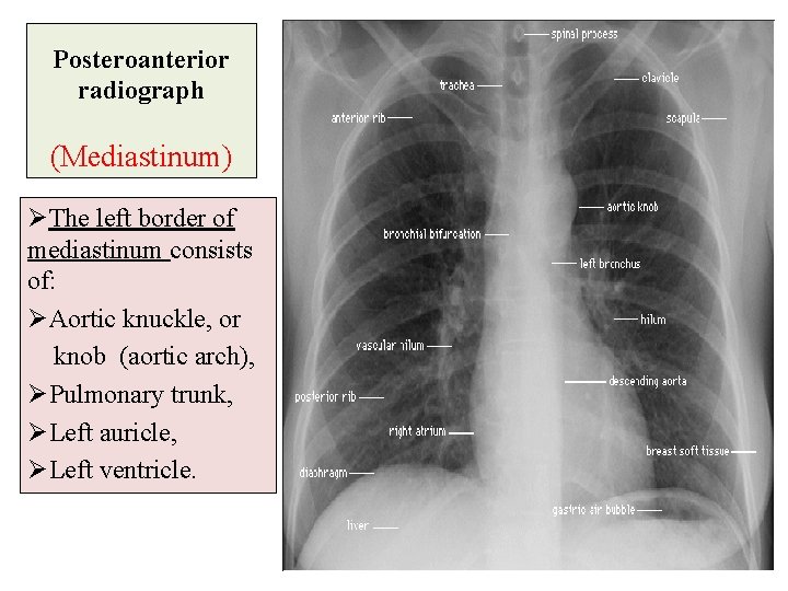 Posteroanterior radiograph (Mediastinum) ØThe left border of mediastinum consists of: ØAortic knuckle, or knob