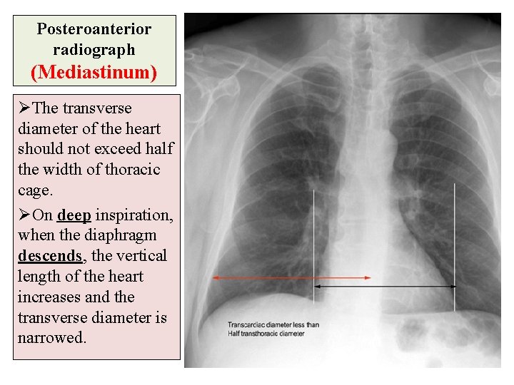 Posteroanterior radiograph (Mediastinum) ØThe transverse diameter of the heart should not exceed half the