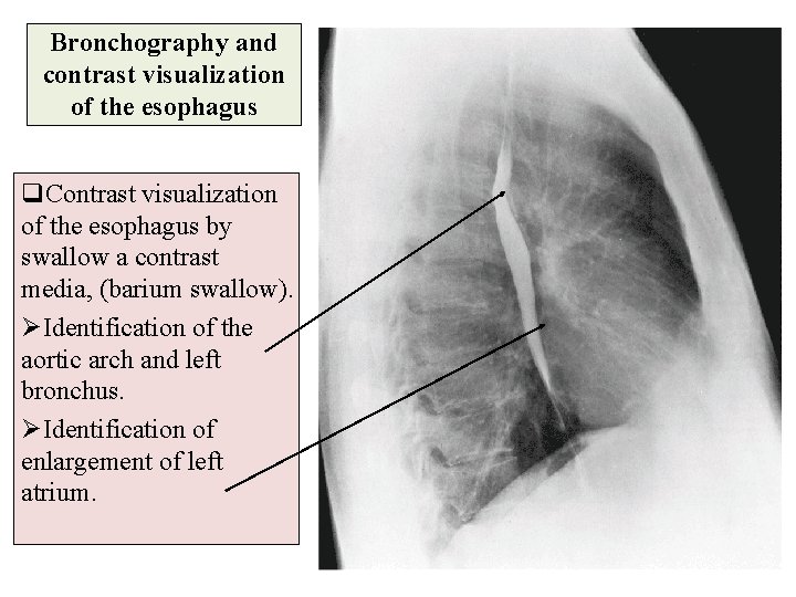 Bronchography and contrast visualization of the esophagus q. Contrast visualization of the esophagus by