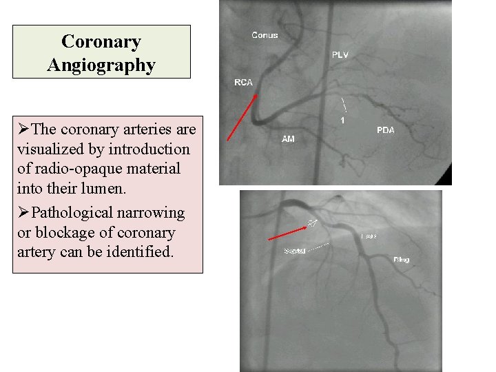Coronary Angiography ØThe coronary arteries are visualized by introduction of radio-opaque material into their