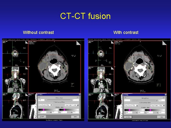 CT-CT fusion Without contrast With contrast 