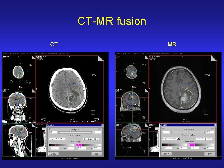 CT-MR fusion CT MR 