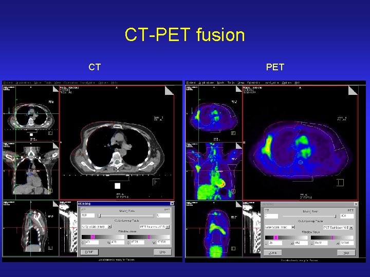 CT-PET fusion CT PET 
