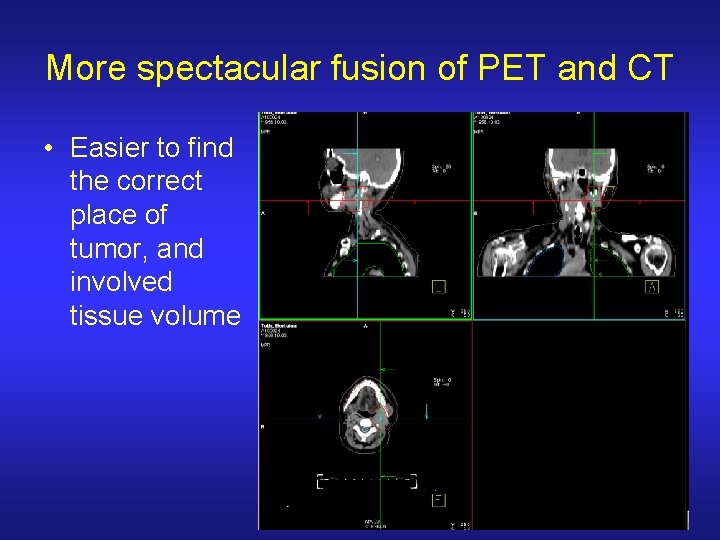 More spectacular fusion of PET and CT • Easier to find the correct place