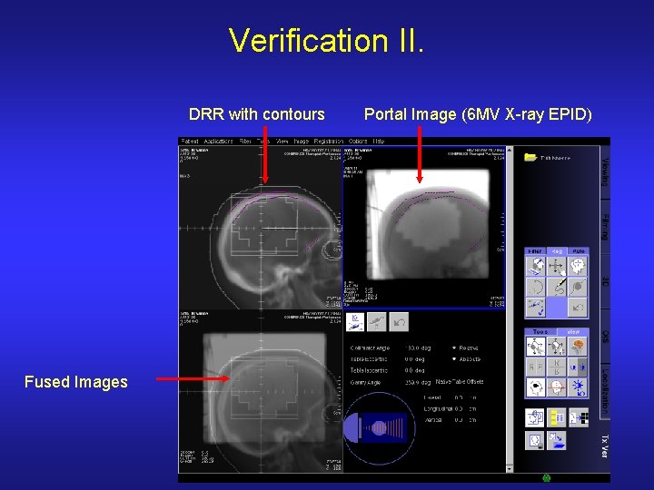 Verification II. DRR with contours Fused Images Portal Image (6 MV X-ray EPID) 