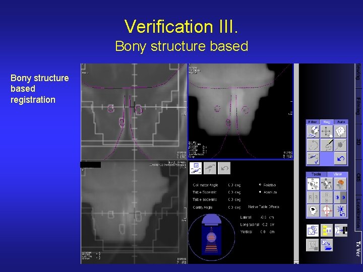 Verification III. Bony structure based registration 