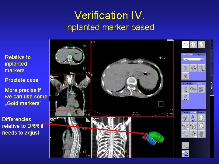 Verification IV. Inplanted marker based Relative to inplanted markers Prostate case More precise if