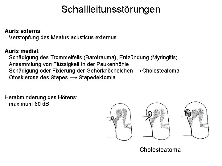 Schallleitunsstörungen Auris externa: Verstopfung des Meatus acusticus externus Auris medial: Schädigung des Trommelfells (Barotrauma),