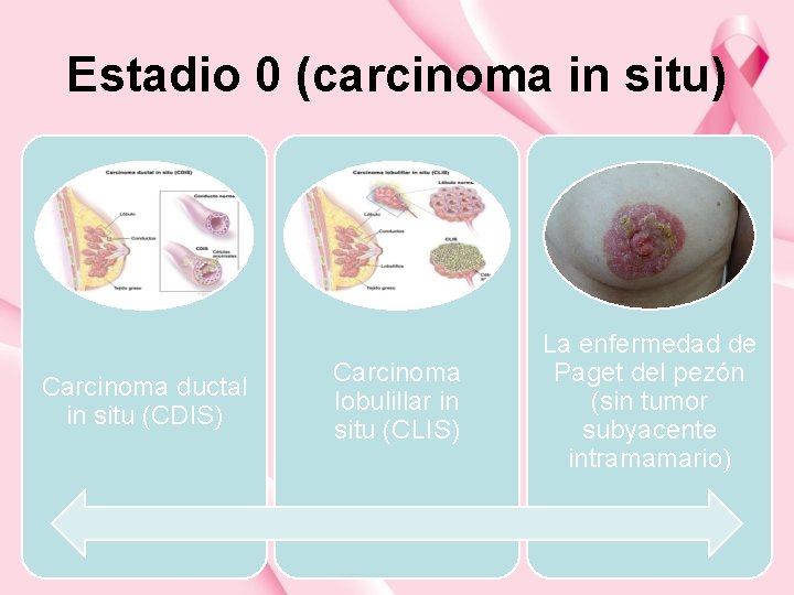 Estadio 0 (carcinoma in situ) Carcinoma ductal in situ (CDIS) Carcinoma lobulillar in situ