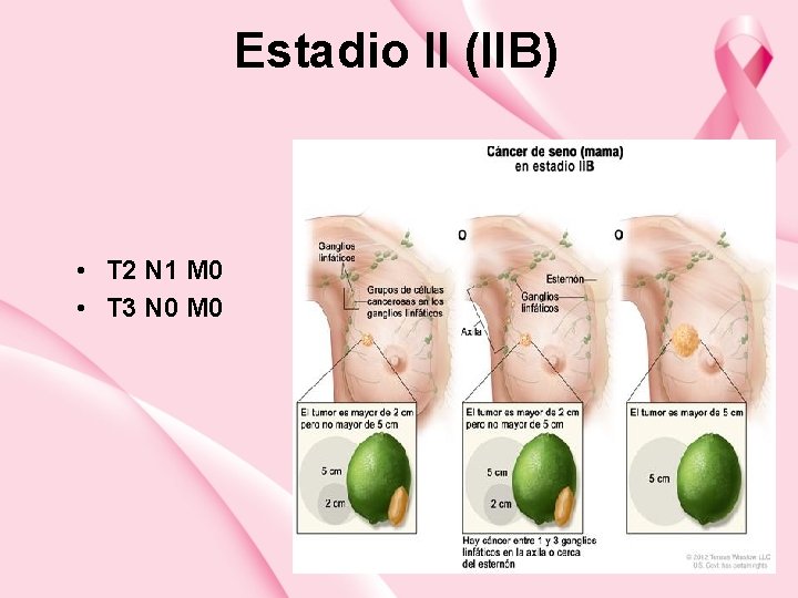 Estadio II (IIB) • T 2 N 1 M 0 • T 3 N