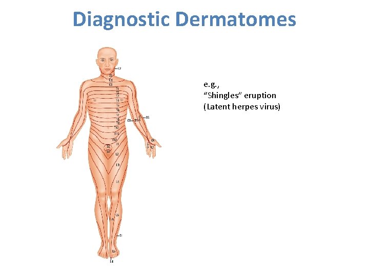 Diagnostic Dermatomes e. g. , “Shingles” eruption (Latent herpes virus) 