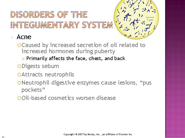 Acne Caused by increased secretion of oil related to increased hormones during puberty