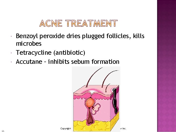  Benzoyl peroxide dries plugged follicles, kills microbes Tetracycline (antibiotic) Accutane – inhibits sebum