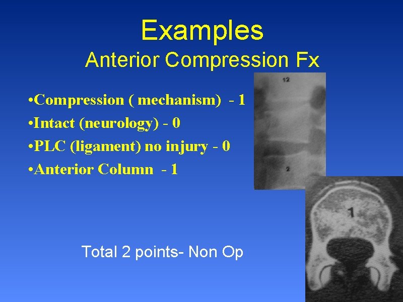 Examples Anterior Compression Fx • Compression ( mechanism) - 1 • Intact (neurology) -