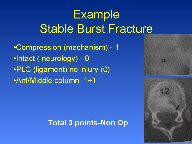 Example Stable Burst Fracture • Compression (mechanism) - 1 • Intact ( neurology) -