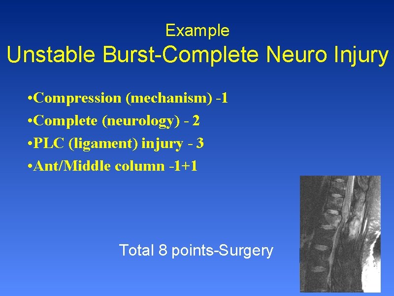 Example Unstable Burst-Complete Neuro Injury • Compression (mechanism) -1 • Complete (neurology) - 2