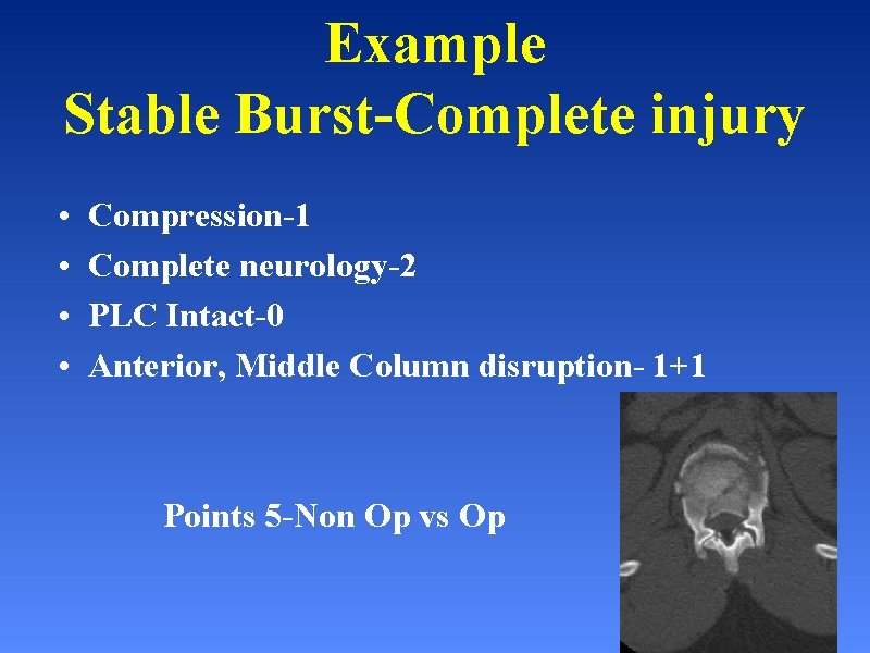 Example Stable Burst-Complete injury • • Compression-1 Complete neurology-2 PLC Intact-0 Anterior, Middle Column