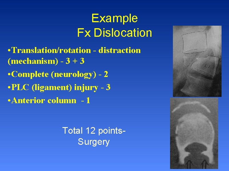 Example Fx Dislocation • Translation/rotation - distraction (mechanism) - 3 + 3 • Complete