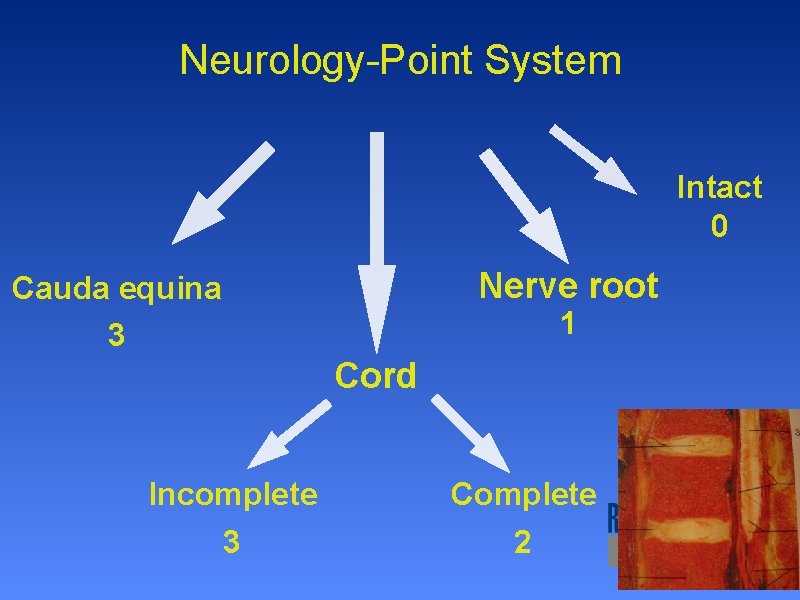 Neurology-Point System Intact 0 Nerve root Cauda equina 3 1 Cord Incomplete 3 Complete