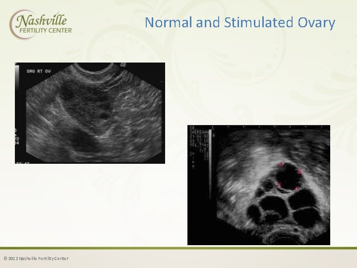 Normal and Stimulated Ovary © 2012 Nashville Fertility Center 