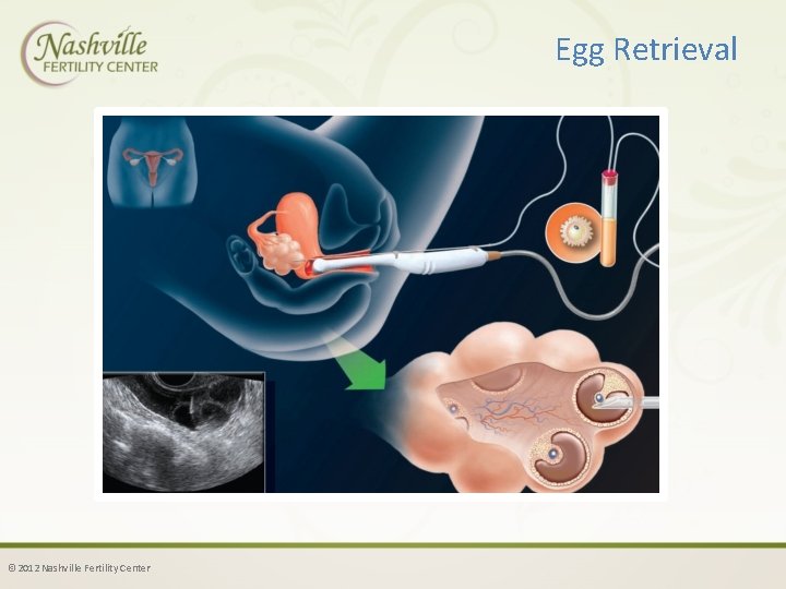 Egg Retrieval © 2012 Nashville Fertility Center 