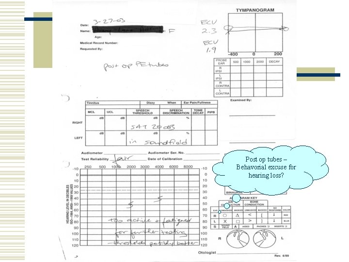 Post op tubes – Behavorial excuse for hearing loss? 