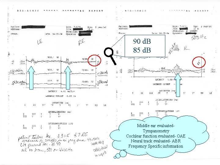 90 d. B 85 d. B Middle ear evaluated. Tympanometry Cochlear function evaluated- OAE