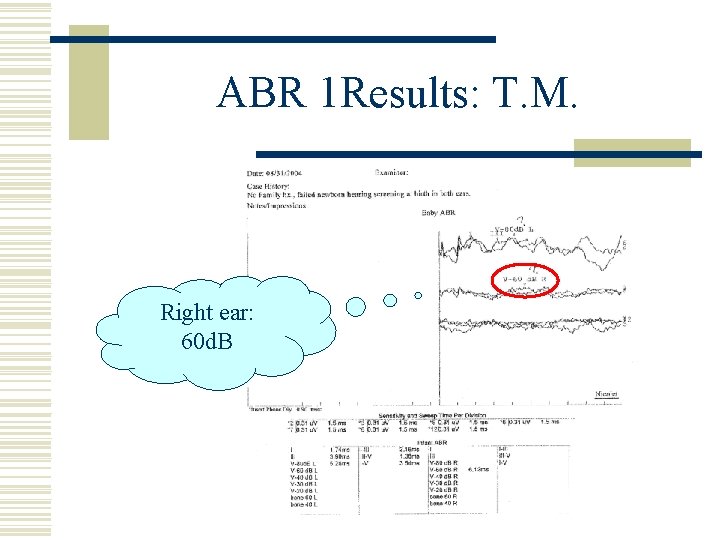 ABR 1 Results: T. M. Right ear: 60 d. B 