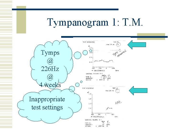 Tympanogram 1: T. M. Tymps @ 226 Hz @ 4 weeks Inappropriate test settings