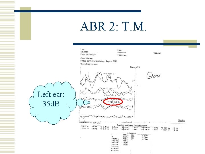 ABR 2: T. M. Left ear: 35 d. B 