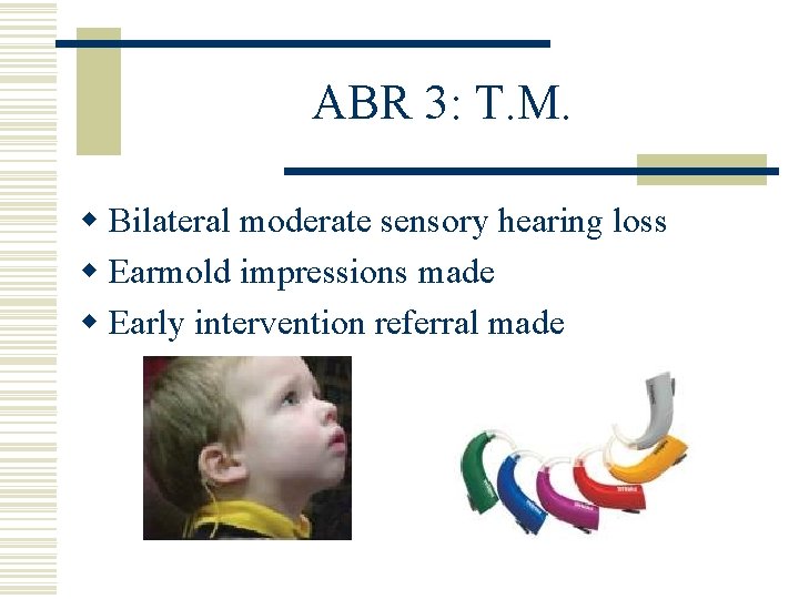 ABR 3: T. M. w Bilateral moderate sensory hearing loss w Earmold impressions made