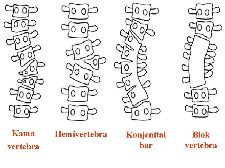 Kama vertebra Hemivertebra Konjenital bar Blok vertebra 15 