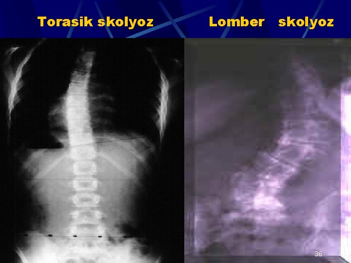 Torasik skolyoz Lomber skolyoz 36 