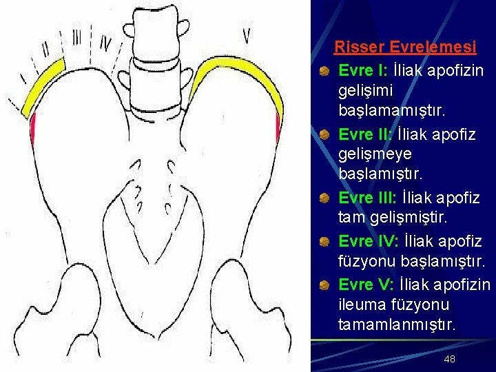 Risser Evrelemesi Evre I: İliak apofizin gelişimi başlamamıştır. Evre II: İliak apofiz gelişmeye başlamıştır.