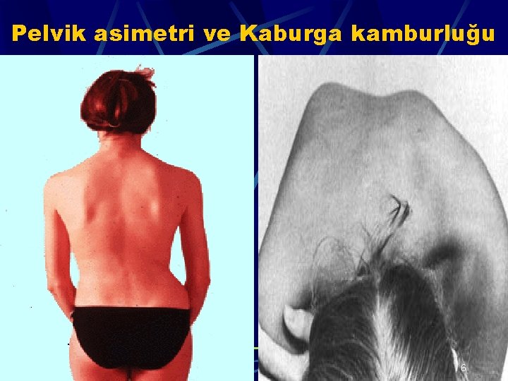 Pelvik asimetri ve Kaburga kamburluğu 6 