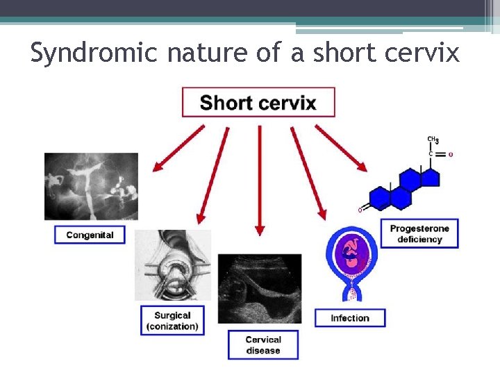 Syndromic nature of a short cervix 