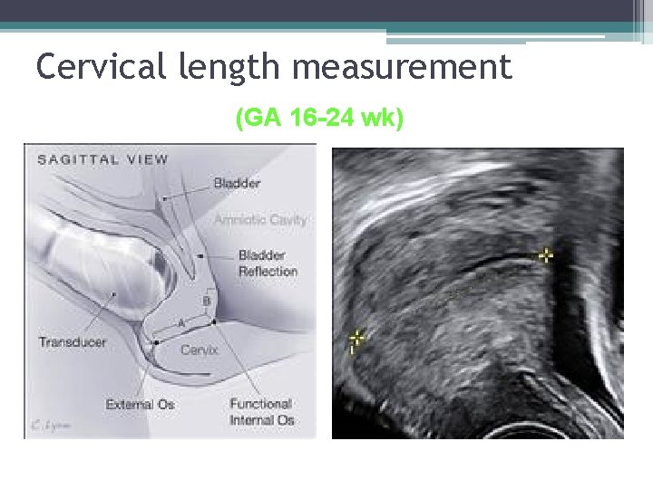 Cervical length measurement (GA 16 -24 wk) 