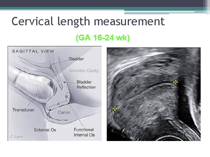Cervical length measurement (GA 16 -24 wk) Cervical length measurement (GA 16 -24 wk)