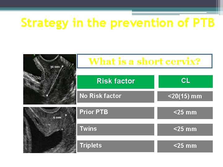 Strategy in the prevention of PTB What is a short cervix? Risk factor No