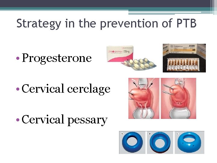 Strategy in the prevention of PTB • Progesterone • Cervical cerclage • Cervical pessary Strategy in the prevention of PTB • Progesterone • Cervical cerclage • Cervical pessary