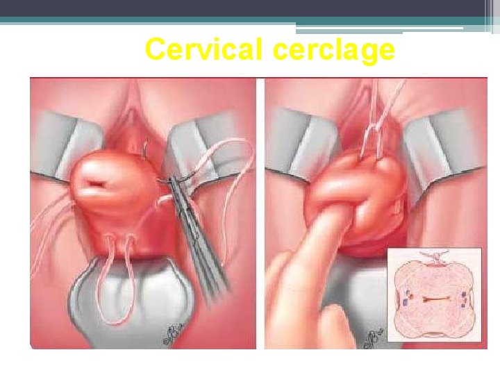 Cervical cerclage Cervical cerclage