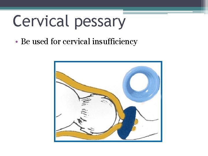 Cervical pessary • Be used for cervical insufficiency Cervical pessary • Be used for cervical insufficiency